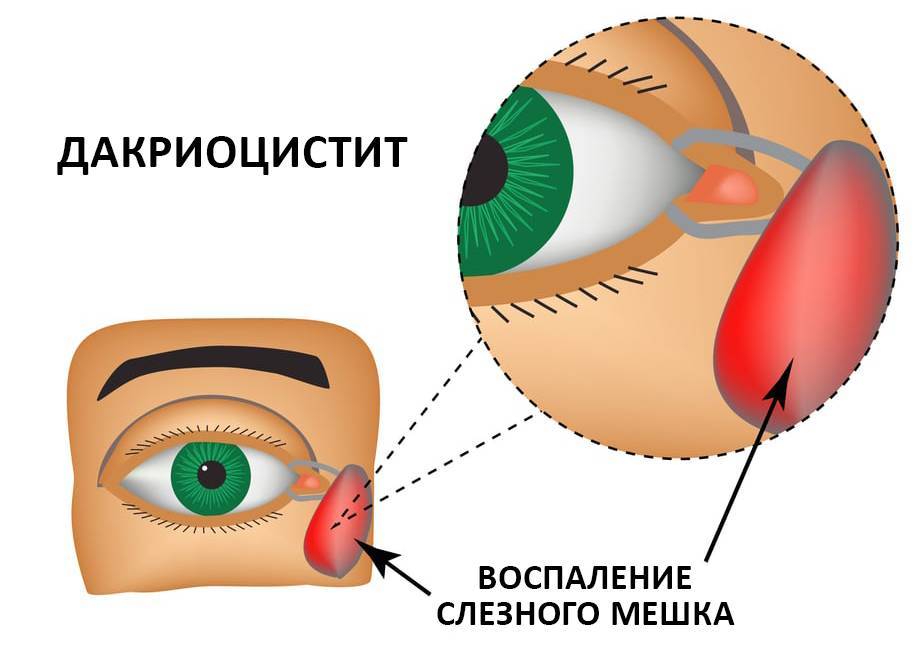 Дакриоцистит - лечение в сети салонов оптики «Арника» 