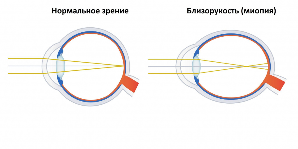 Симптомы миопии - сеть салонов «Арника» 